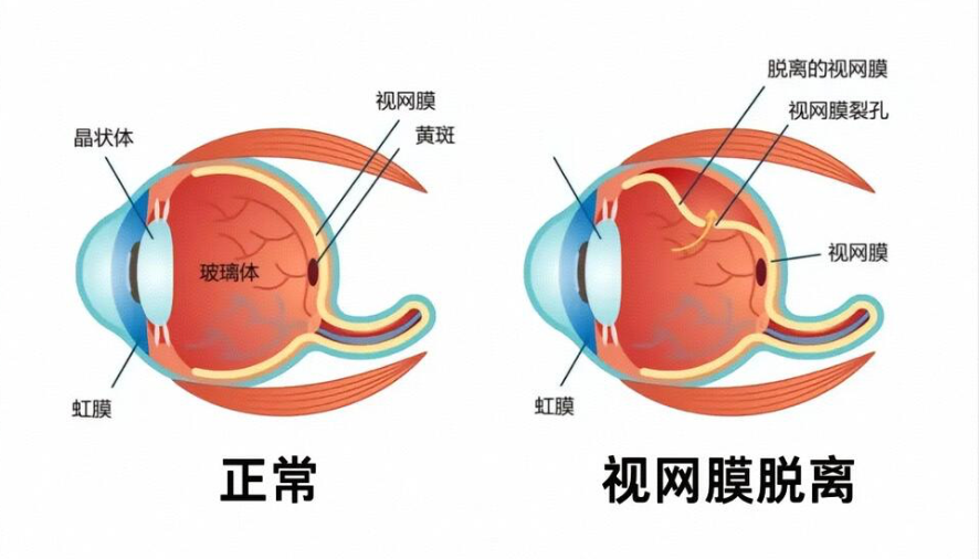 视网膜脱落5个常见问题：出现这些前兆，别拖延！