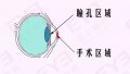眼科医生给近视手术者的9个注意事项