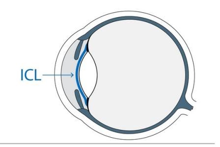 晶体植入类近视手术原理