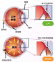 眼睛出现这些疑似青光眼症状，请立即、马上就诊