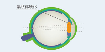 白内障科