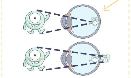 我散光高，可以做近视手术矫正吗？