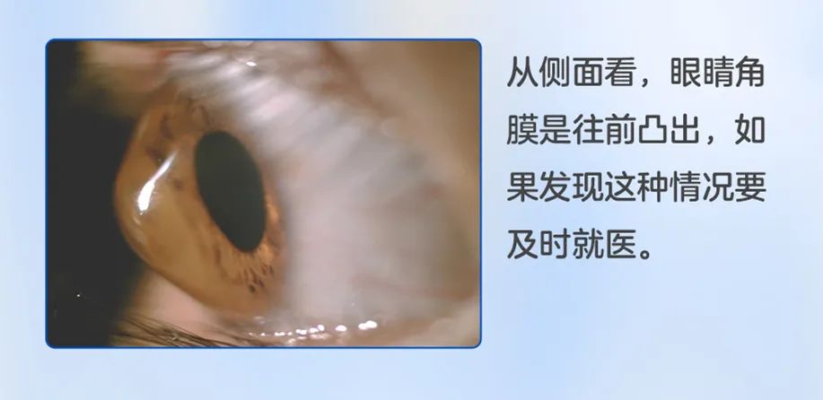 为什么会得圆锥角膜？怎么知道自己得圆锥角膜？