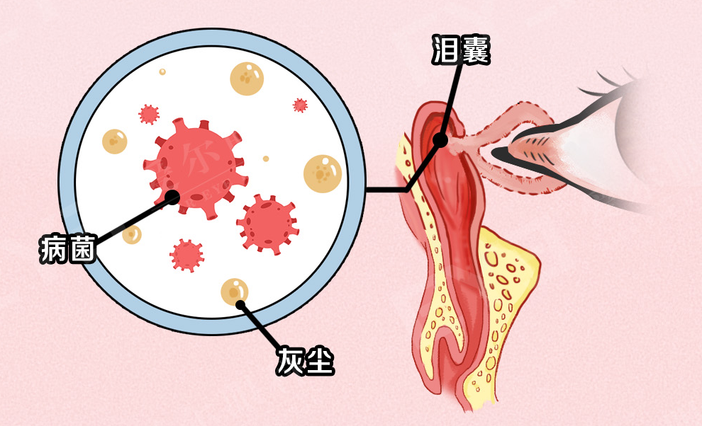 早上起床为什么眼屎增多？