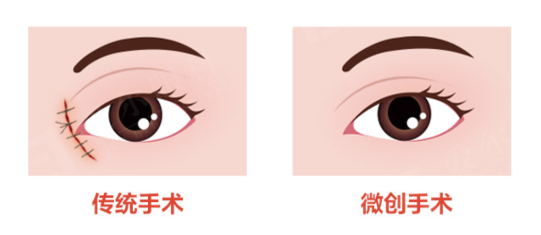 泪道阻塞怎么治疗?