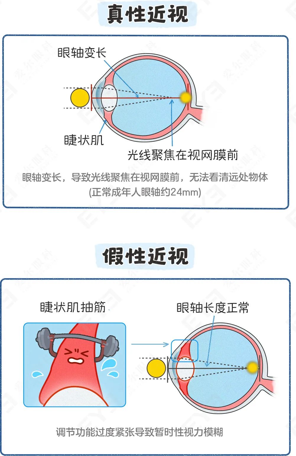 真性近视.jpg