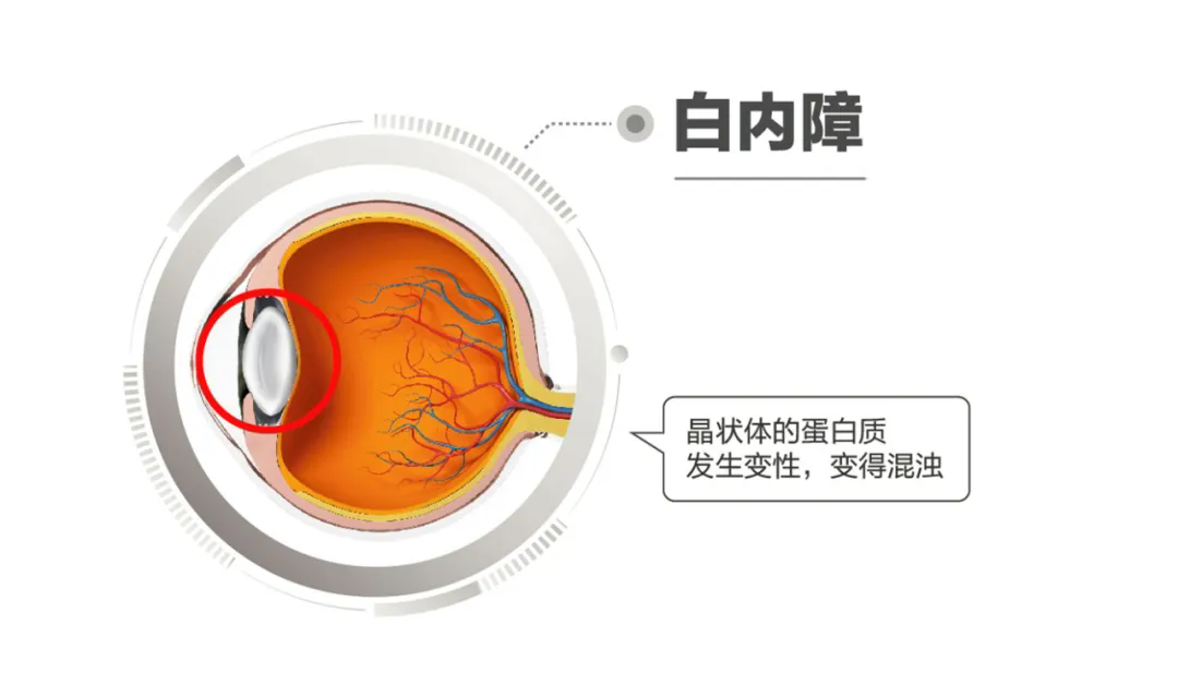 别让 “年龄” 挡了光明！八九十岁老人白内障，手术到底值不值？