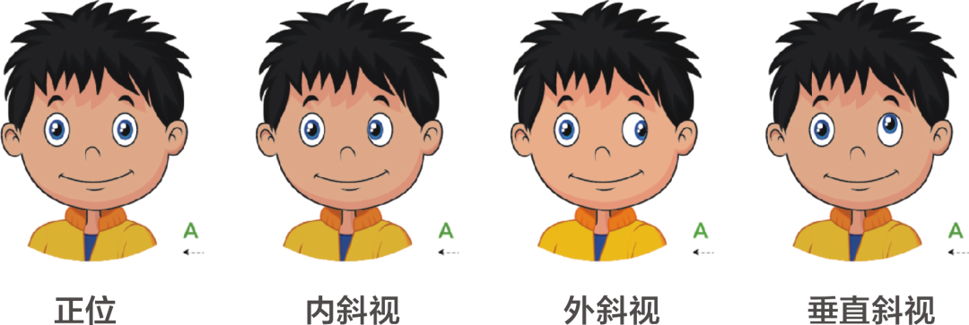 还在等孩子长大再治斜视？这些危害你必须知道