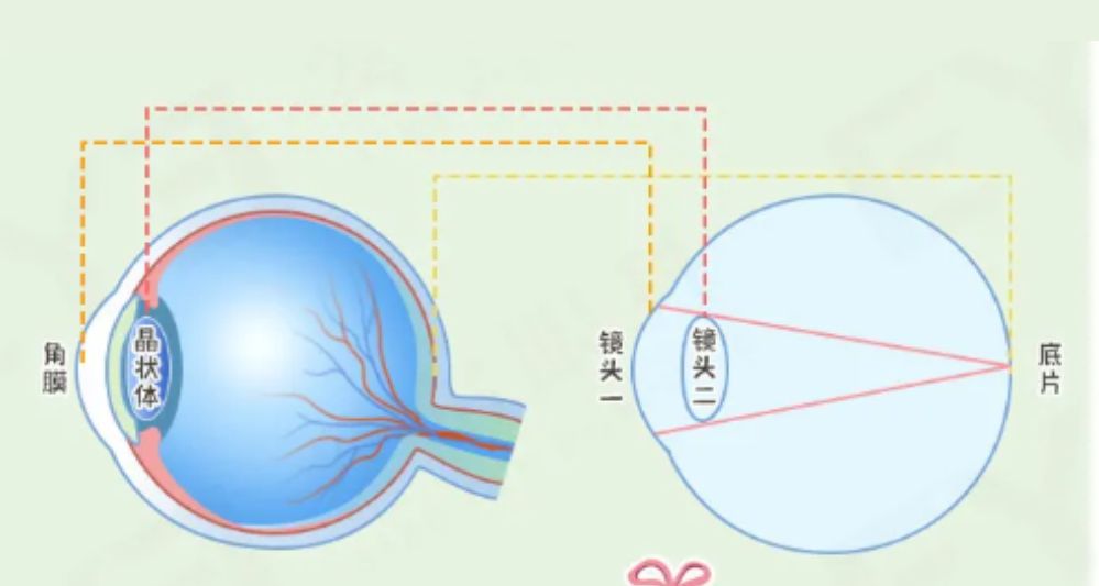 做完白内障手术就万事大吉？术后常见问题及注意事项一定要了解…
