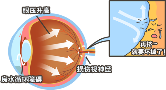 别被这些误区耽误！青光眼，不止是“老年病”