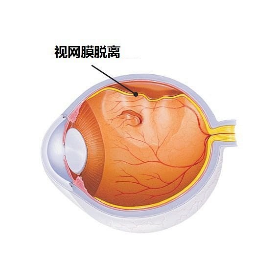 警惕！黑点飘、闪光感、视物遮挡——这些信号可能指向视网膜脱离，你是高危人群吗？