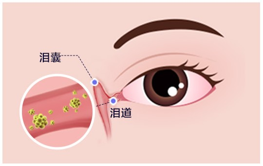 一吹风就流泪，真的不是眼睛敏感！原来问题出在这里！
