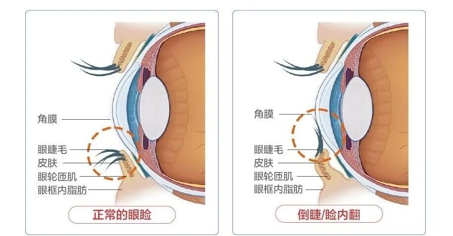 睫毛倒着长、频繁揉眼？南宁眼科提醒您：倒睫拖不得，当心划伤角膜