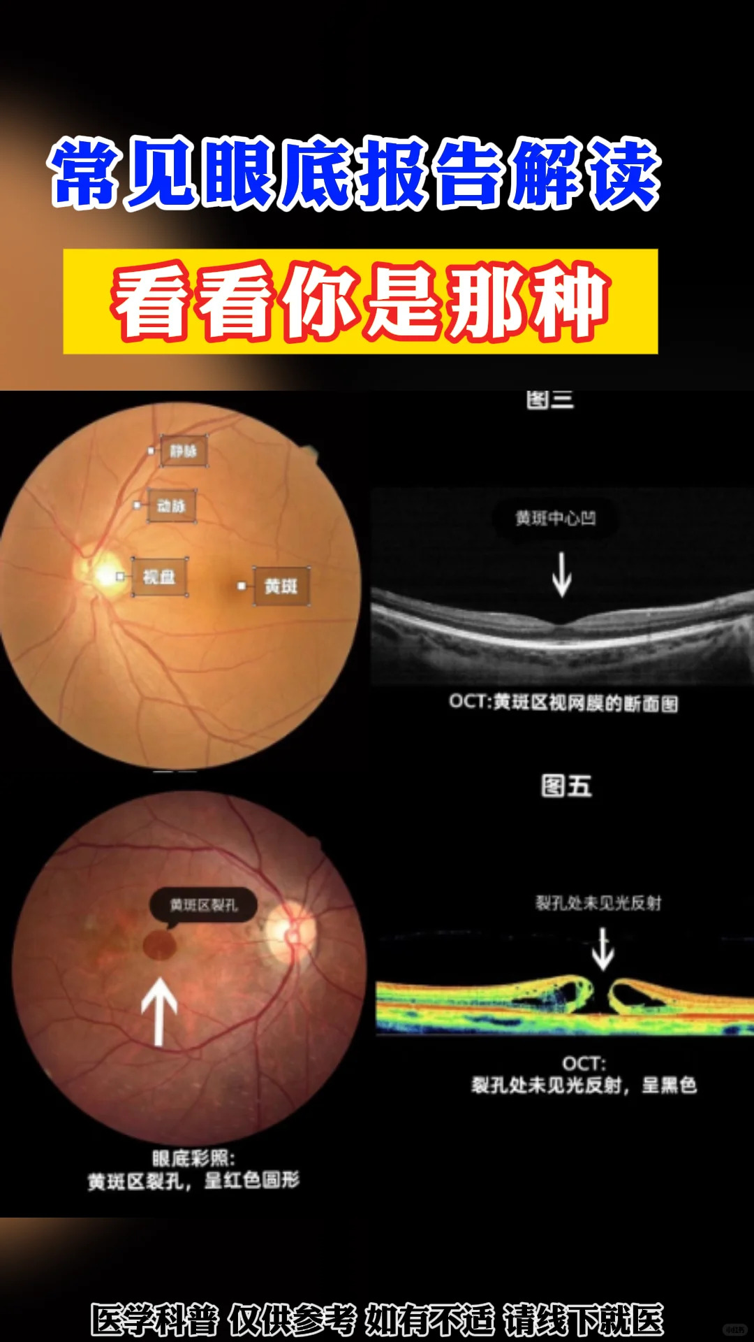 常见眼底报告解读 看看你是那种_1_眼科医生欧阳丽_来自小红书网页版.jpg