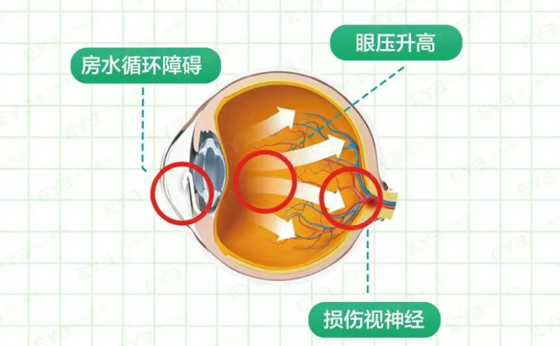 青光眼8.6-1.png