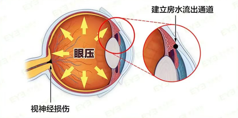 青光眼8.6-3.png