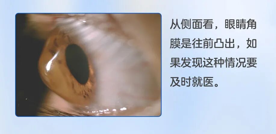 圆锥角膜.jpg