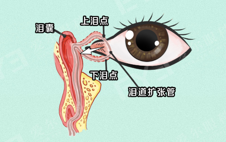 泪道4.png