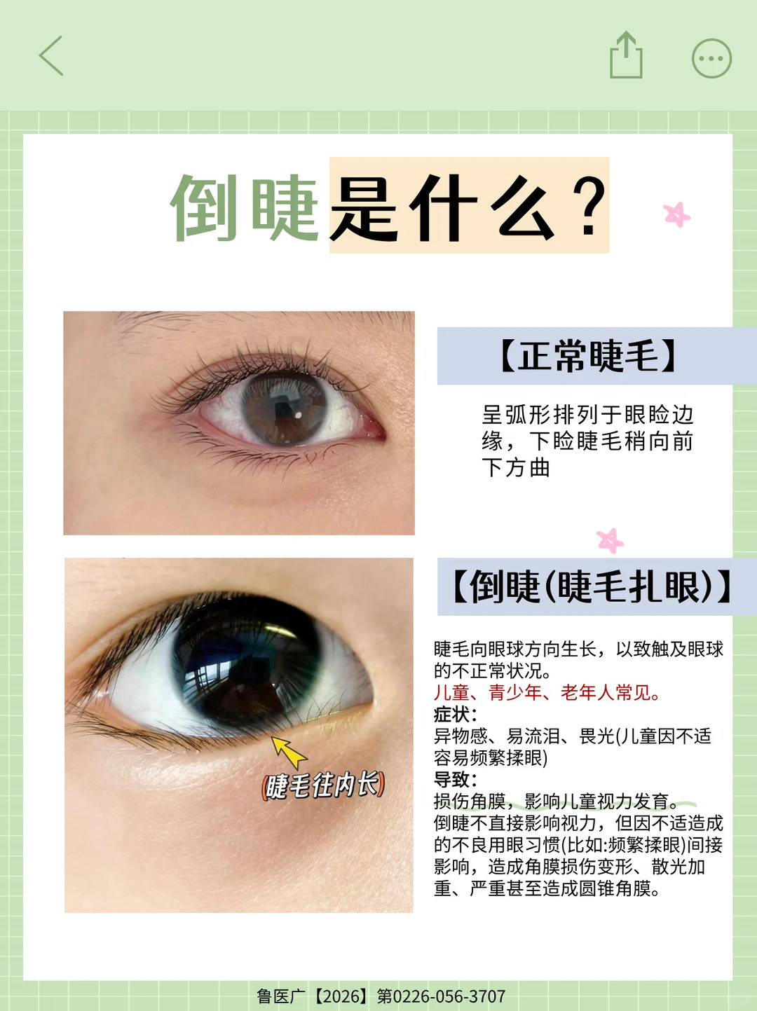 倒睫是什么？眼睛总像进了沙子、又扎又痛怎么回事？倒睫手术怎么做？南宁人必看的倒睫全攻略