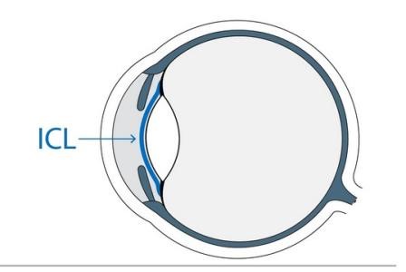ICL晶体植入术(图1)